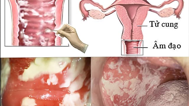 Viêm phụ khoa do nấm candida có chữa được không?