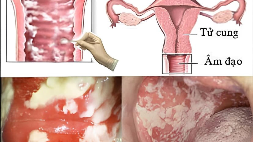 Viêm phụ khoa do nấm candida có chữa được không?