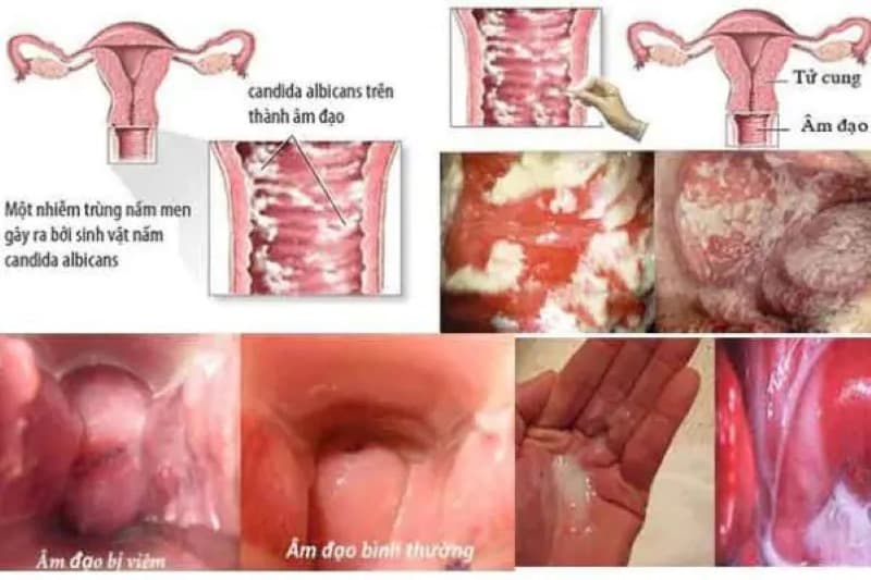 Viêm phụ khoa do nấm candida có chữa được không?