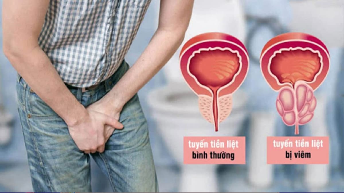 Viêm tuyến tiền liệt là gì? Dấu hiệu, nguyên nhân và cách điều trị
