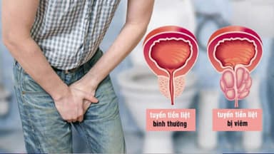 Viêm tuyến tiền liệt là gì? Dấu hiệu, nguyên nhân và cách điều trị