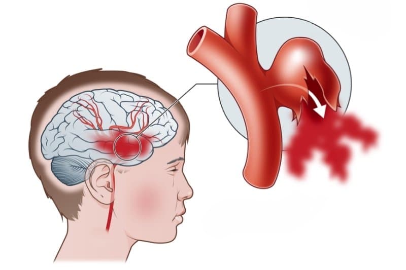 vỡ túi phình mạch máu não
