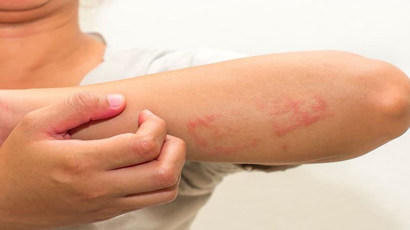 viêm có lợi hay có hại
