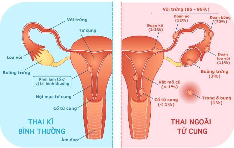 Các yếu tố nguy cơ thai ngoài tử cung