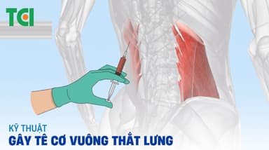 Gây tê cơ vuông thắt lưng: Giải pháp giảm đau hiệu quả, an toàn cho mọi phẫu thuật