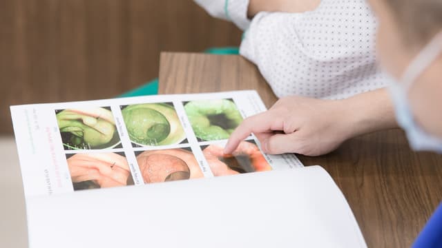 Dấu hiệu ung thư đại tràng giai đoạn 0