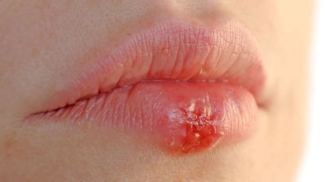 Danh sách bác sĩ giỏi chữa mụn rộp sinh dục ở Hoàng Mai