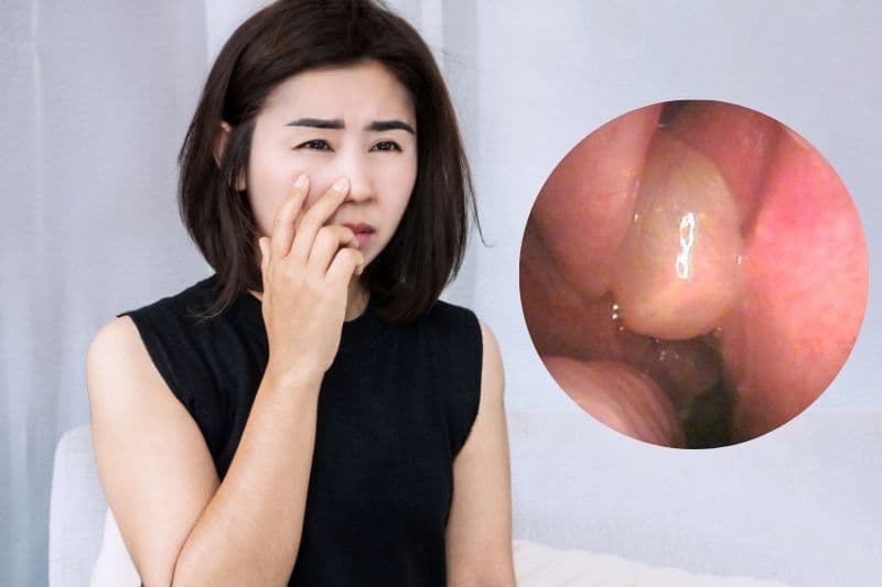 polyp mũi có gây ung thư không