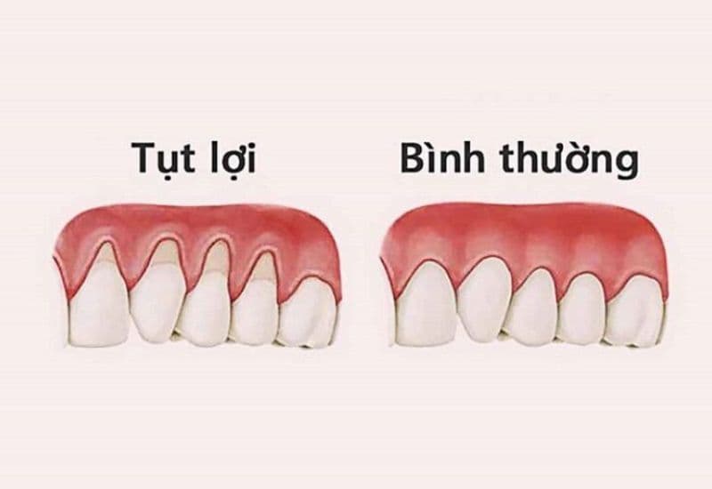 bị tụt lợi có nguy hiểm không