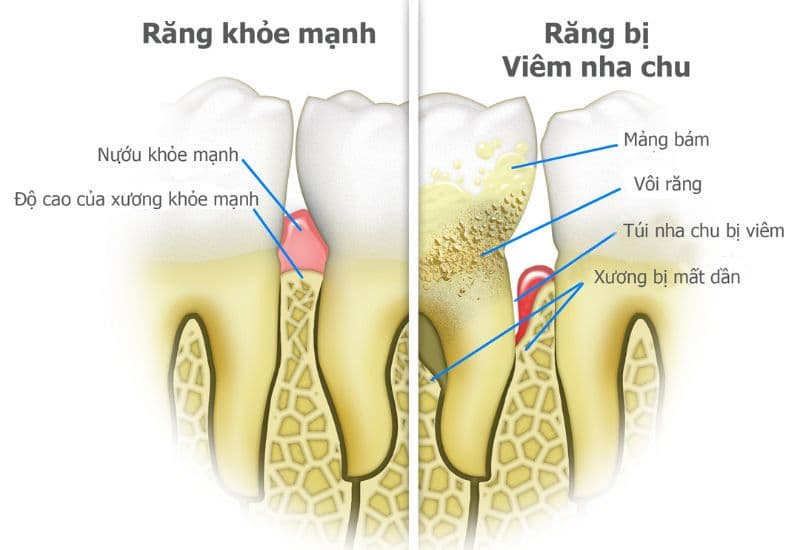 bị tụt lợi có nguy hiểm không