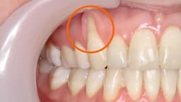 Bị tụt lợi có nguy hiểm không?