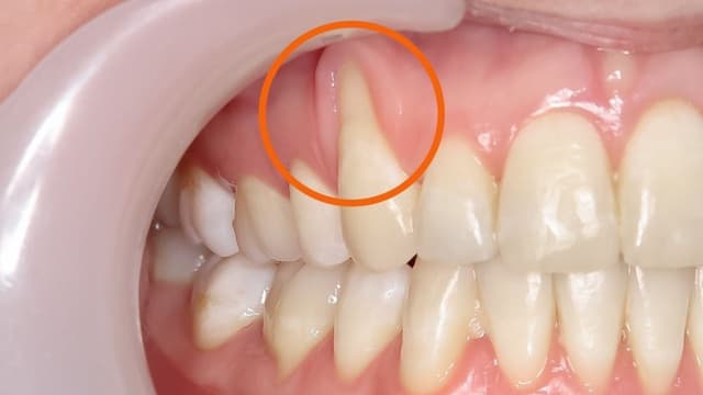 Bị tụt lợi có nguy hiểm không?