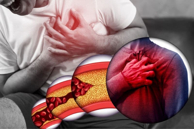 hậu quả của xơ vữa mạch máu