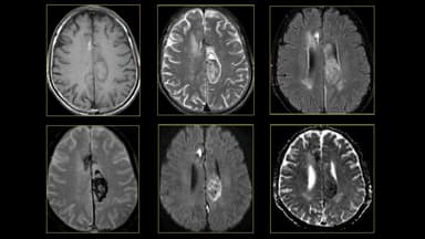 Các giai đoạn xuất huyết não trên MRI