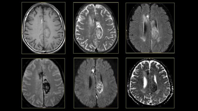 Các giai đoạn xuất huyết não trên MRI