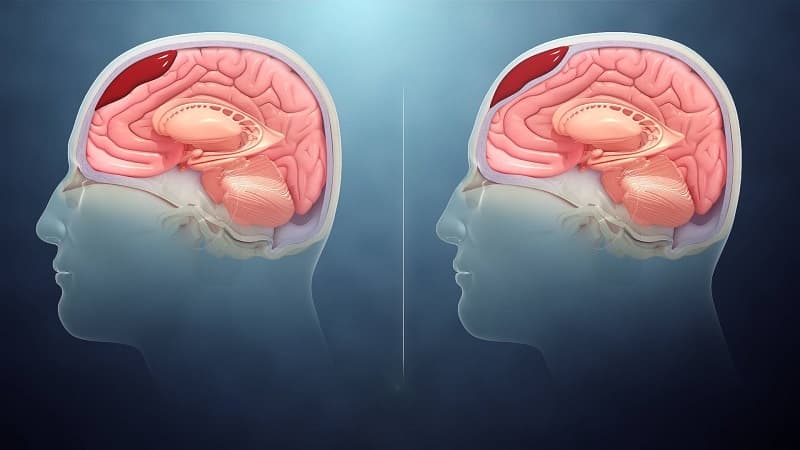 vị trí xuất huyết não do tăng huyết áp