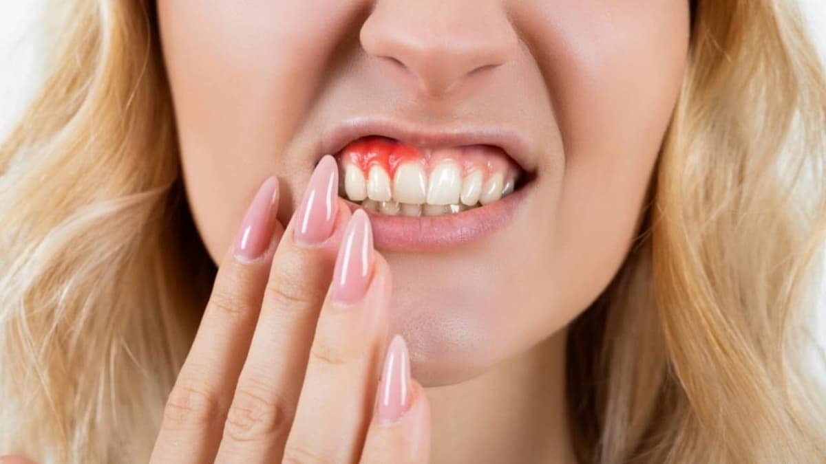 Cách chữa viêm lợi tại nhà nhanh nhất
