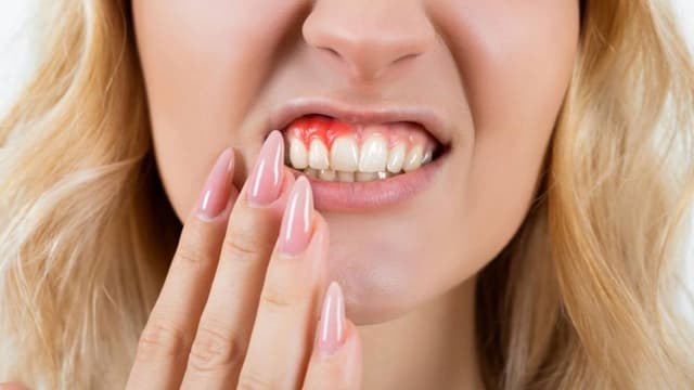 Cách chữa viêm lợi tại nhà nhanh nhất