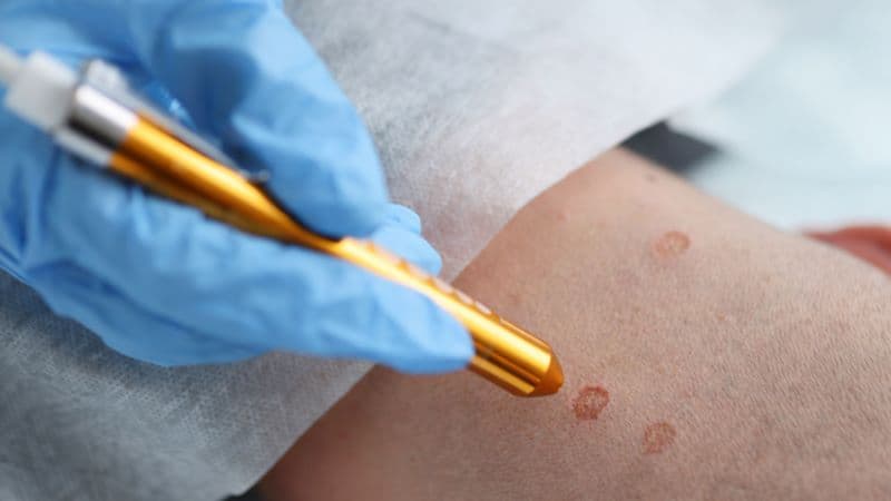 Điều trị sùi mào gà ở đâu tốt tại Linh Đàm?