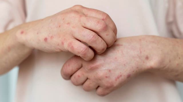 Chi phí điều trị giang mai ở Đại Từ gồm những khoản gì?