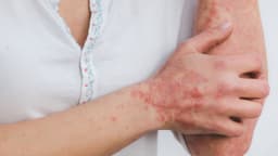 Tìm hiểu chi phí điều trị giang mai và những yếu tố ảnh hưởng