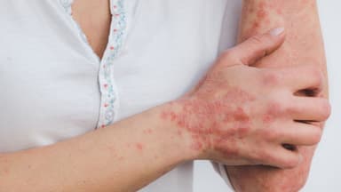 Tìm hiểu chi phí điều trị giang mai và những yếu tố ảnh hưởng