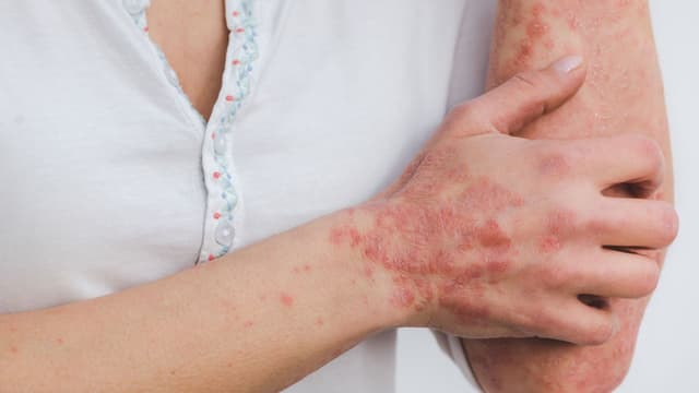 Tìm hiểu chi phí điều trị giang mai và những yếu tố ảnh hưởng