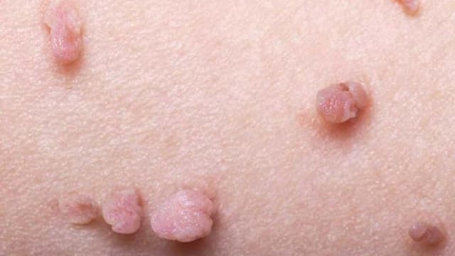 Chi phí điều trị sùi mào gà ở Hoàng Mai bao nhiêu?