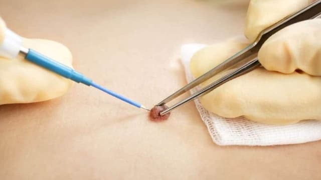 Chi phí điều trị sùi mào gà ở Đại Từ: Những yếu tố ảnh hưởng và địa chỉ thăm khám uy tín