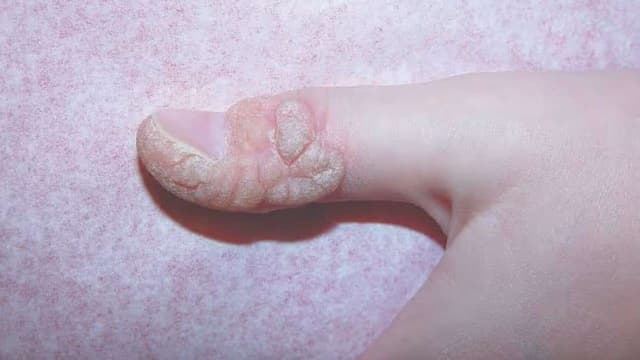 Tìm hiểu chi phí điều trị sùi mào gà ở Linh Đàm và địa chỉ thăm khám uy tín