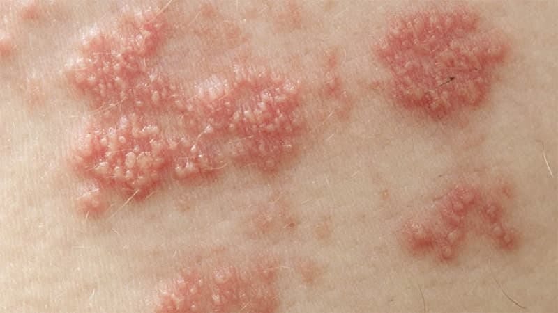 Điều trị mụn rộp sinh dục