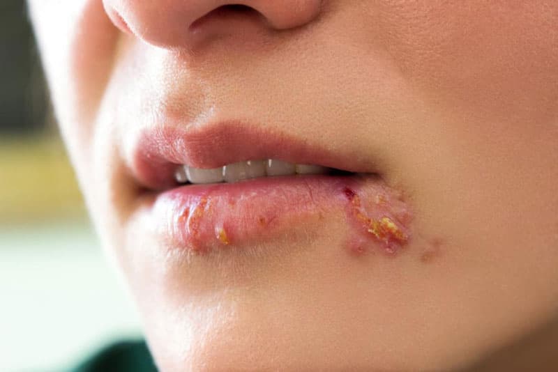 Điều trị mụn rộp sinh dục