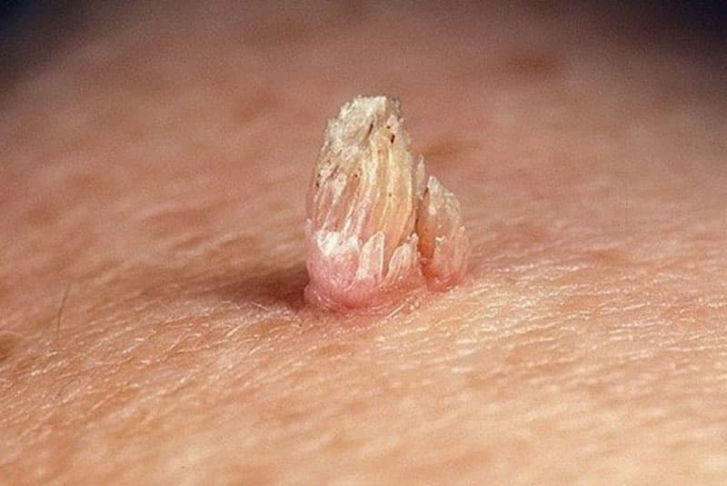 Điều trị sùi mào gà ở Đại Từ: Những điều cần biết