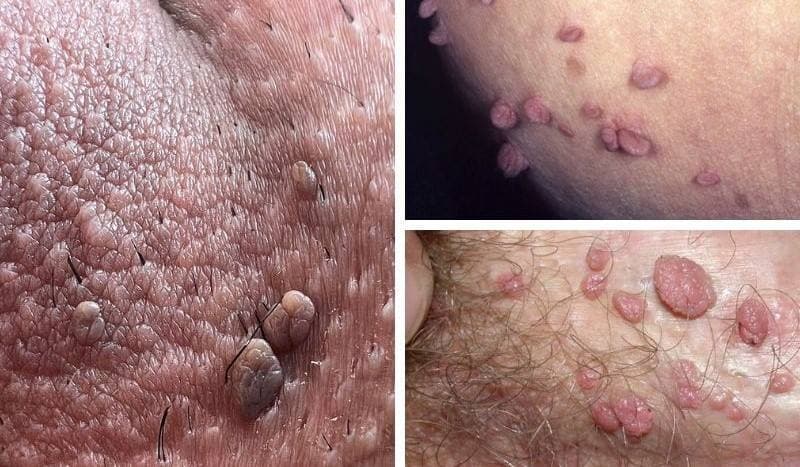 Điều trị sùi mào gà ở Hoàng Mai ở đâu uy tín?