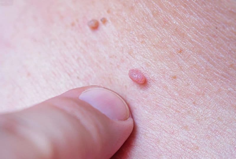 Điều trị sùi mào gà ở Thanh Trì: Địa chỉ khám và lưu ý