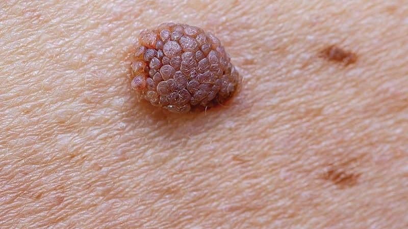 Điều trị sùi mào gà ở đâu tốt tại Linh Đàm?