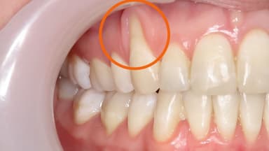 Cách chữa tụt lợi an toàn