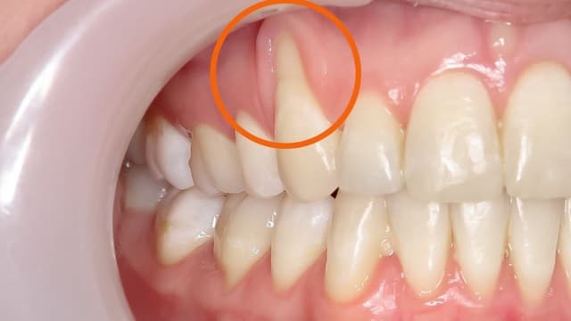 Cách chữa tụt lợi an toàn