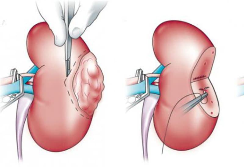 u thận ác tính có chữa được không