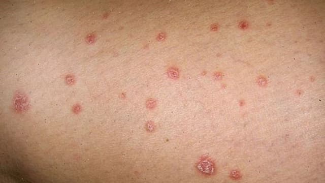 Điều trị giang mai ở Linh Đàm: Địa chỉ uy tín giúp chẩn đoán và điều trị kịp thời