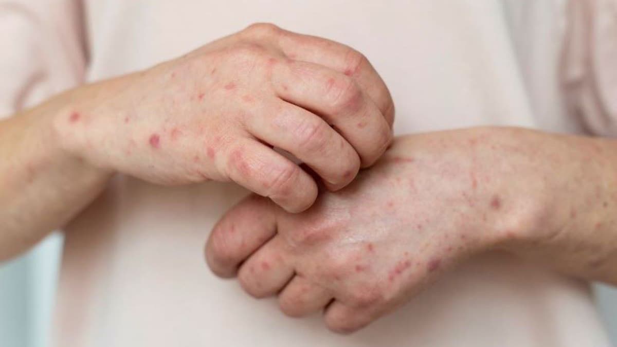 Điều trị giang mai ở Thanh Trì tại đâu uy tín, an toàn và kín đáo?