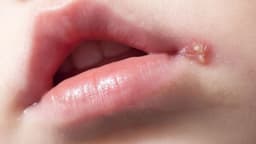 Khi nào cần điều trị mụn rộp sinh dục? Gợi ý địa chỉ chữa mụn rộp sinh dục ở Đại Từ uy tín