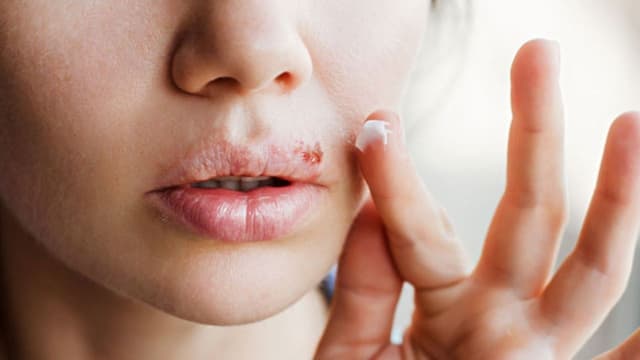 Kinh nghiệm lựa chọn địa chỉ điều trị mụn rộp sinh dục ở Thanh Trì uy tín, khám nhanh, bác sĩ tận tâm