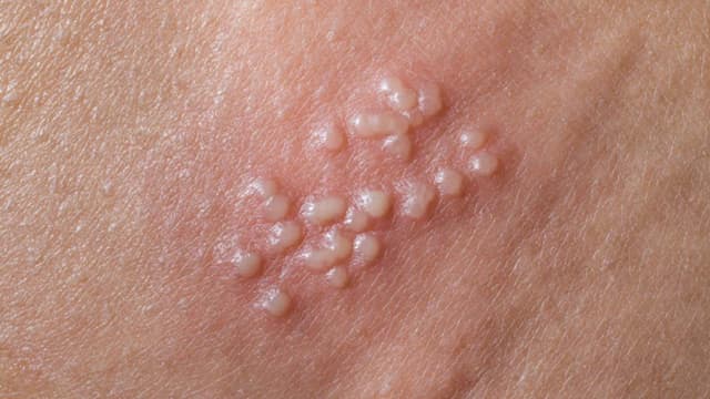 Điều trị mụn rộp sinh dục ở đâu tốt tại Linh Đàm?