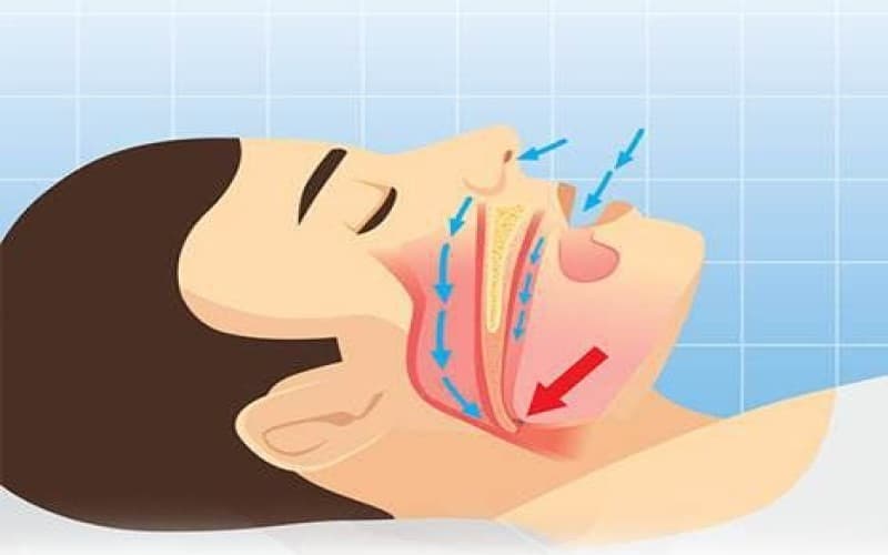 cách điều trị ngủ ngáy ở trẻ em