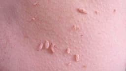 Điều trị sùi mào gà ở Thanh Trì: Địa chỉ khám và lưu ý