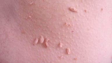 Điều trị sùi mào gà ở Thanh Trì: Địa chỉ khám và lưu ý
