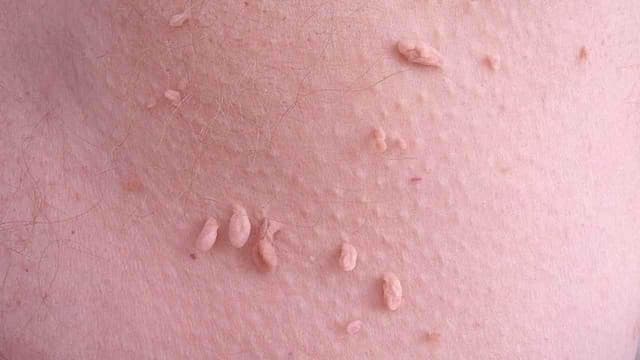 Điều trị sùi mào gà ở Thanh Trì: Địa chỉ khám và lưu ý