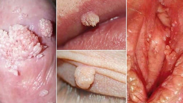 Điều trị sùi mào gà ở đâu tốt tại Linh Đàm?