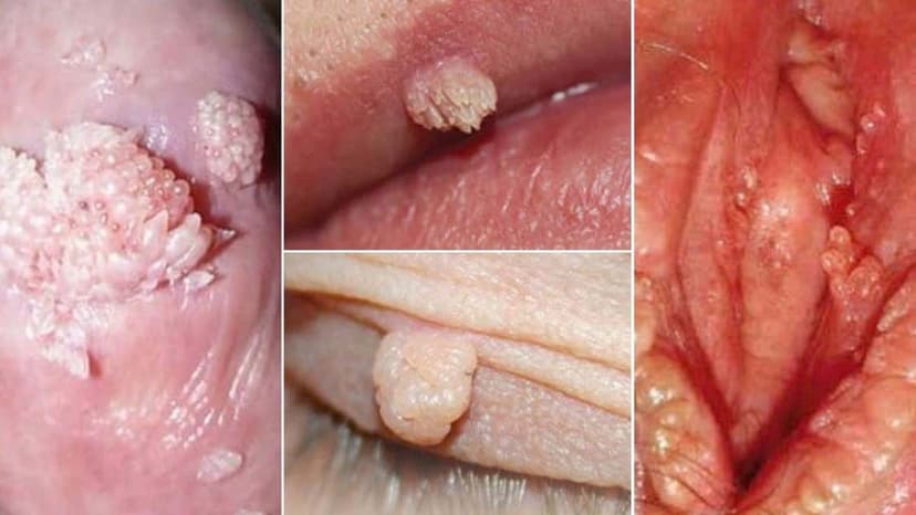 Điều trị sùi mào gà ở đâu tốt tại Linh Đàm?
